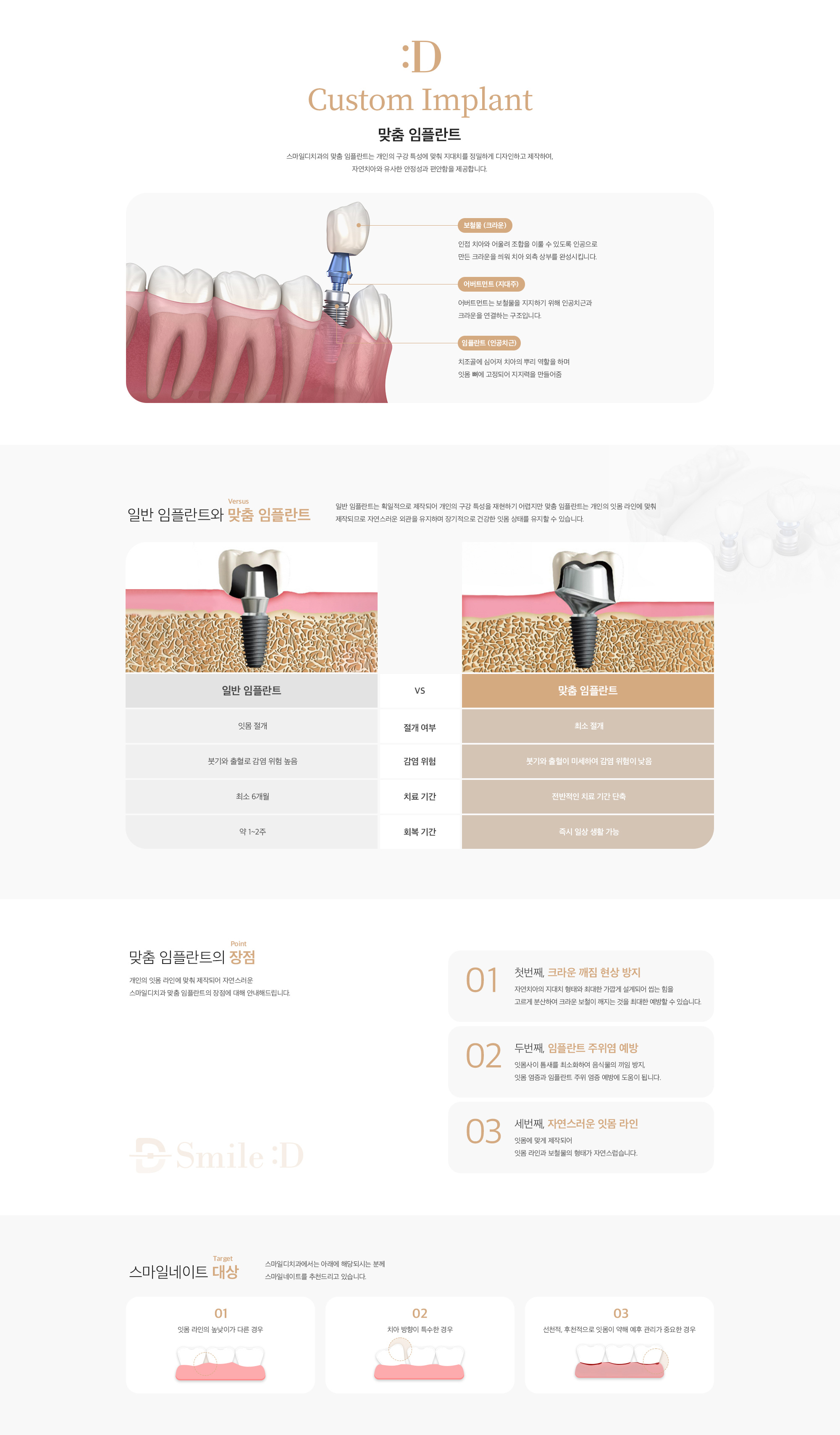 맞춤 임플란트